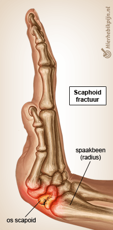 Foto Naviculare fractuur / breuk van het scheepsbotje