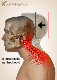 Foto Houdingsgerelateerde nekpijn / tired neck syndrome