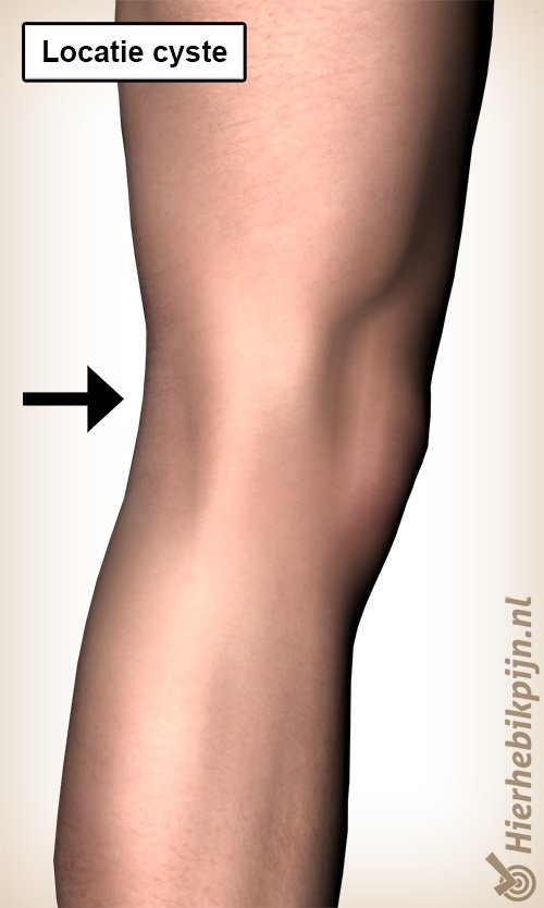 Foto Zwelling in de knieholte / popliteale cyste