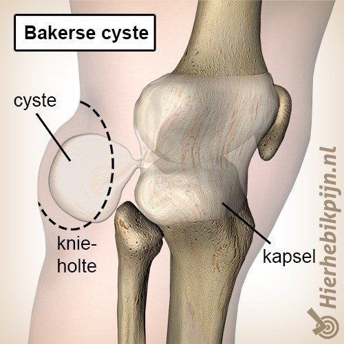 Foto Zwelling in de knieholte / popliteale cyste