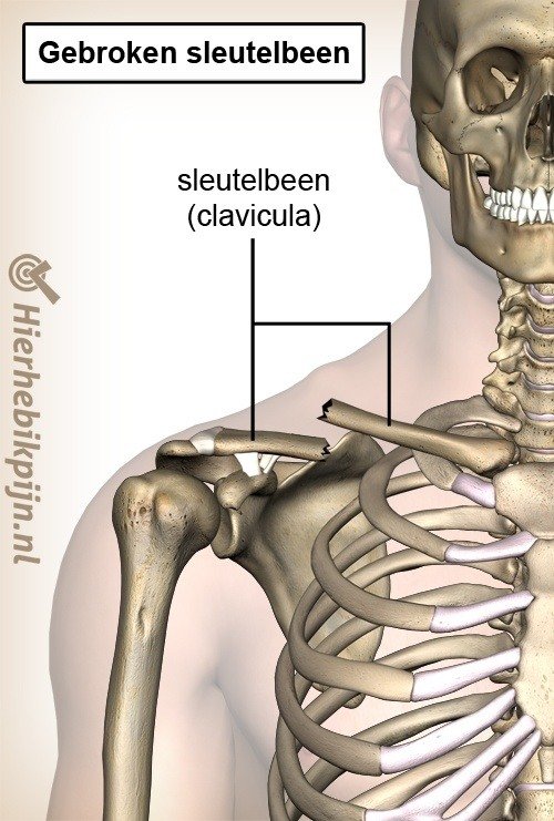 Foto Clavicula fractuur / sleutelbeenbreuk