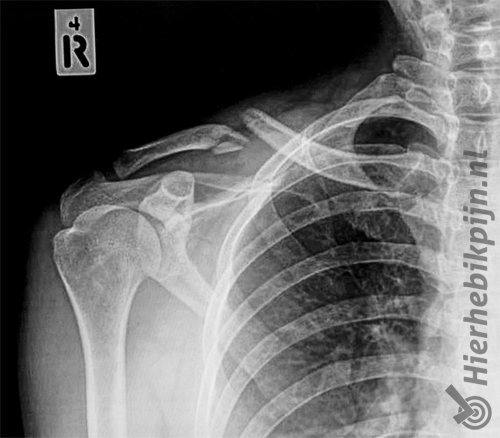 Foto Clavicula fractuur / sleutelbeenbreuk